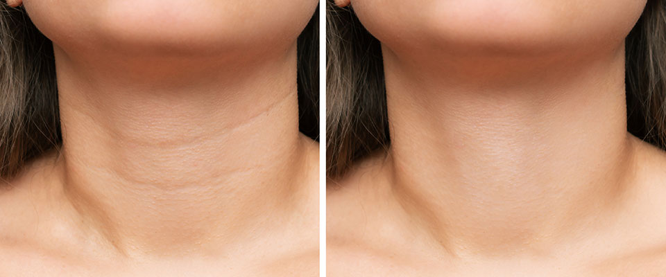 Creme Lifting Firmador Tensor de Rugas em 60 segundos