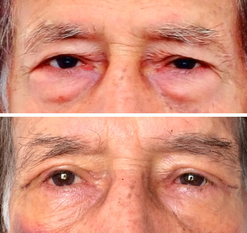 Creme Lifting Firmador Tensor de Rugas em 60 segundos